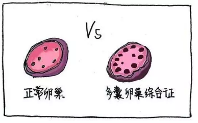 多囊卵巢綜合征與生酮飲食，您不知道的“減肥效果”