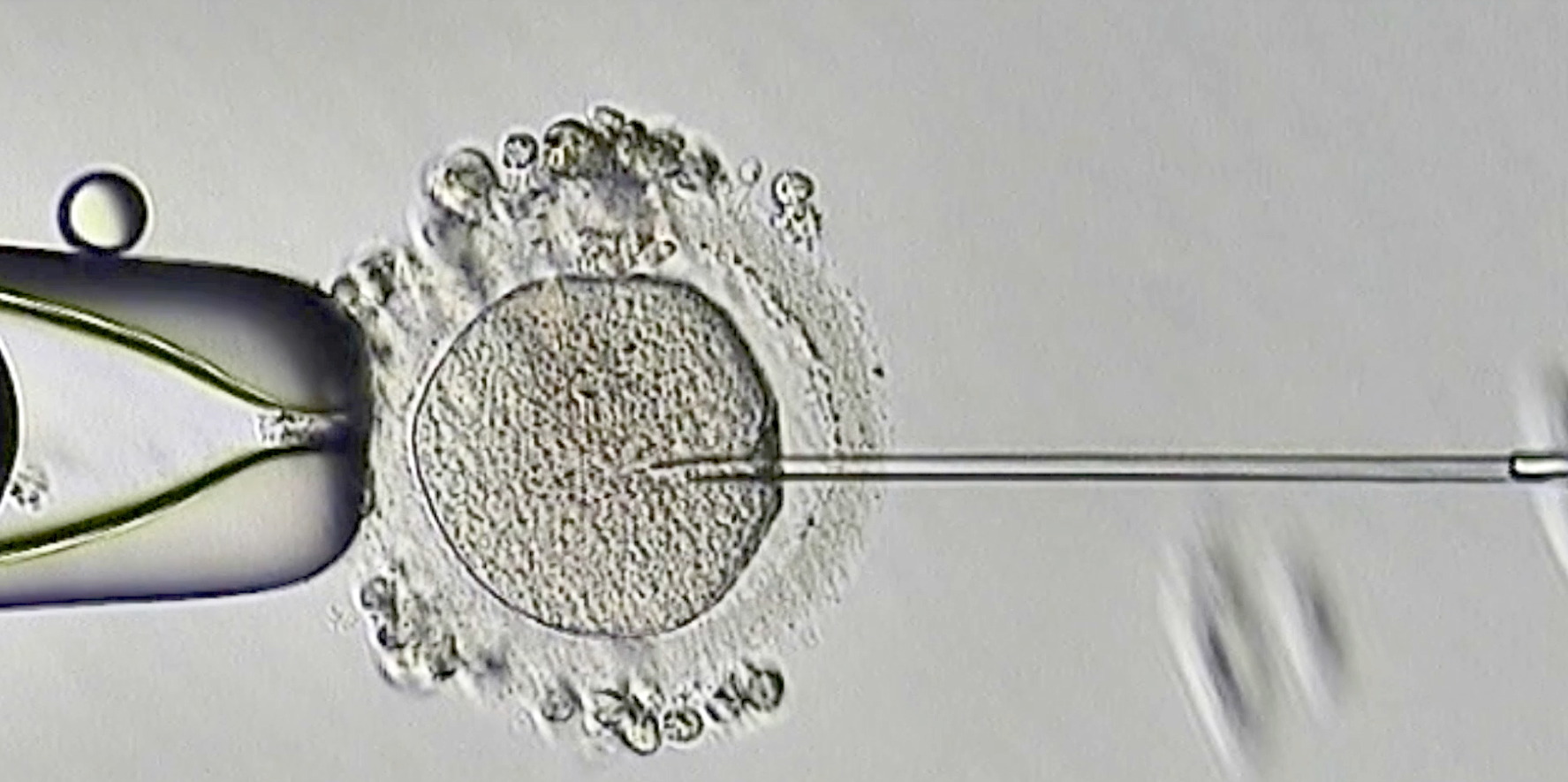 【喜訊】保山首例無精子癥通過試管嬰兒技術(shù)助孕成功！