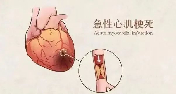 【保山安利醫(yī)院】11月20日“心梗救治日” 時(shí)間就是心肌，時(shí)間就是生命！